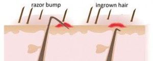 image (artistic) of ingrown hair and razor bump